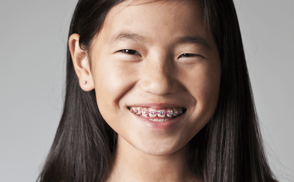 Teen girl smiling with metal braces. Compare Invisalign vs braces for straighter teeth.