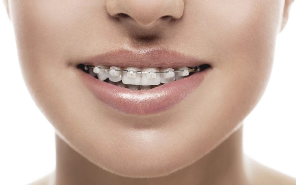 Are clear braces different than traditional braces?