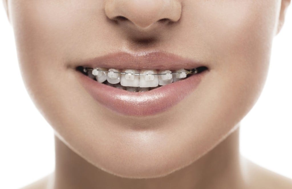 Are clear braces different than traditional braces?