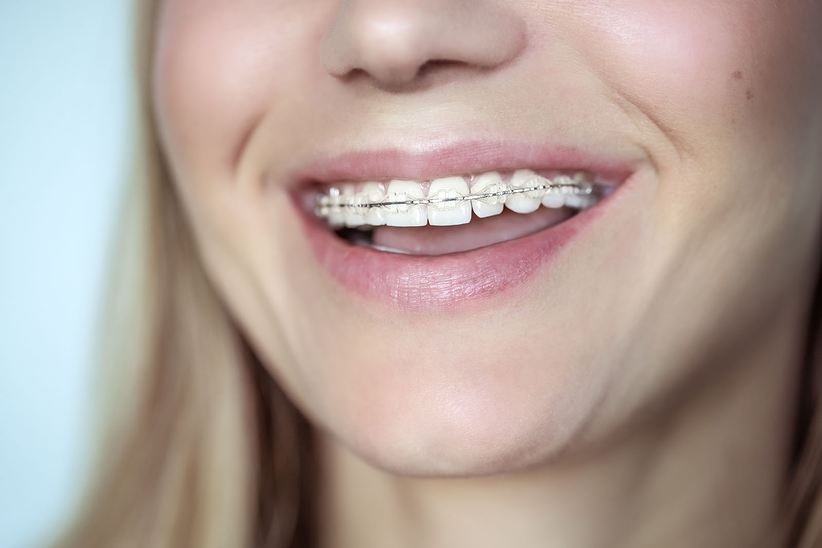 Clear braces provide a nearly invisible way to correct several different types of cases A young woman smiling shows off her clear braces
