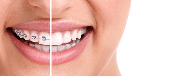 Clear Braces like Invisalign Vs. Traditional Braces