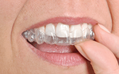 How Does Invisalign Work?