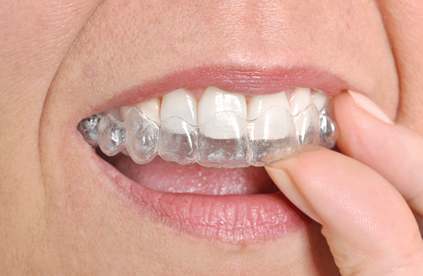 How Does Treatment with Invisalign Work Citrus Heights CA