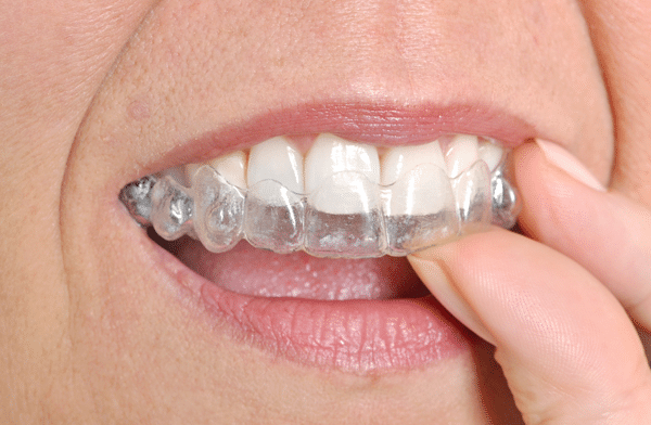 Why So Many Patients are Choosing Invisalign in Rosemont, CA