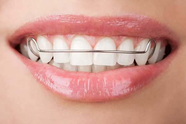 I Completed My Treatment with Invisalign. Now What?