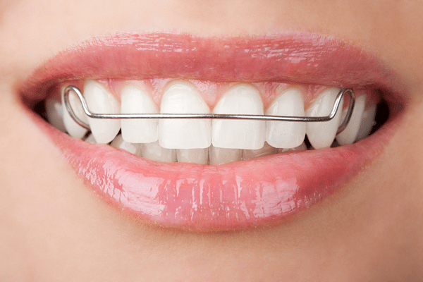 close up of woman's mouth wearing a retainer, Sacramento, CA