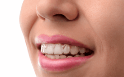 Invisalign Vs. Smile Direct Club