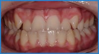 Austin's teeth before treatment with Invisalign Teen