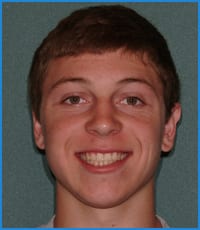 Austin's smile after treatment with Invisalign Teen