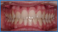 Austin's teeth after treatment with Invisalign Teen