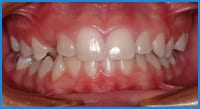 Calvin's teeth before treatment