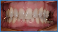 Carol's teeth before treatment with clear aligners