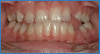 Caroleana's teeth before treatment