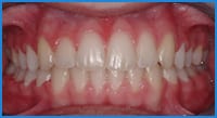 Caroleana's teeth after treatment