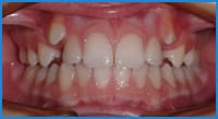 Crocket's teeth before treatment