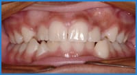 Earp's teeth before treatment