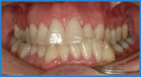 Greg's teeth before treatment