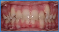 Haileigh's teeth before treatment