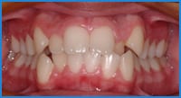 Havva's teeth before treatment
