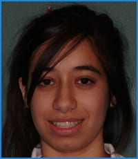 Havva's smile after treatment with the orthodontist