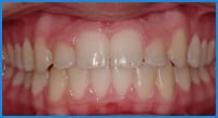 Havva's teeth after treatment