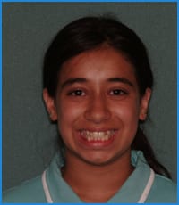 Havva's smile before treatment with the orthodontist