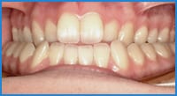 Jaquelin's teeth before treatment