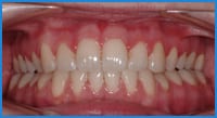 Jaquelin's teeth after treatment