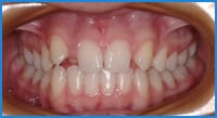 Kathryn's teeth before treatment