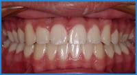 Lee's teeth after treatment