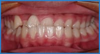 Lee's teeth before treatment