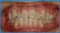 Lim's teeth before treatment