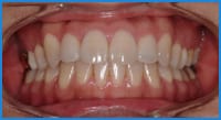 Lim's teeth after treatment