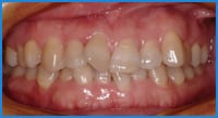 Sohyung teeth before treatment