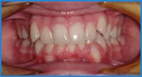Arielle's teeth before treatment