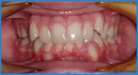 Arielle's teeth before Invisalign treatment