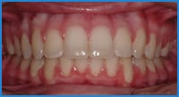 Arielle's teeth after Invisalign treatment