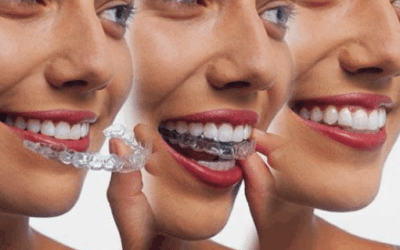 Invisalign Vs. Braces