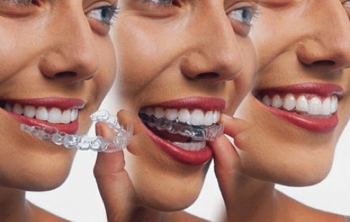 Invisalign Vs. Braces