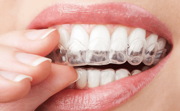 close up of woman inserting clear aligners