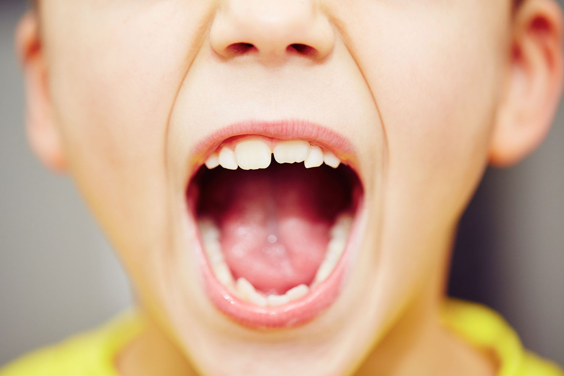 young boy with open mouth showing crowded teeth needing early orthodontics