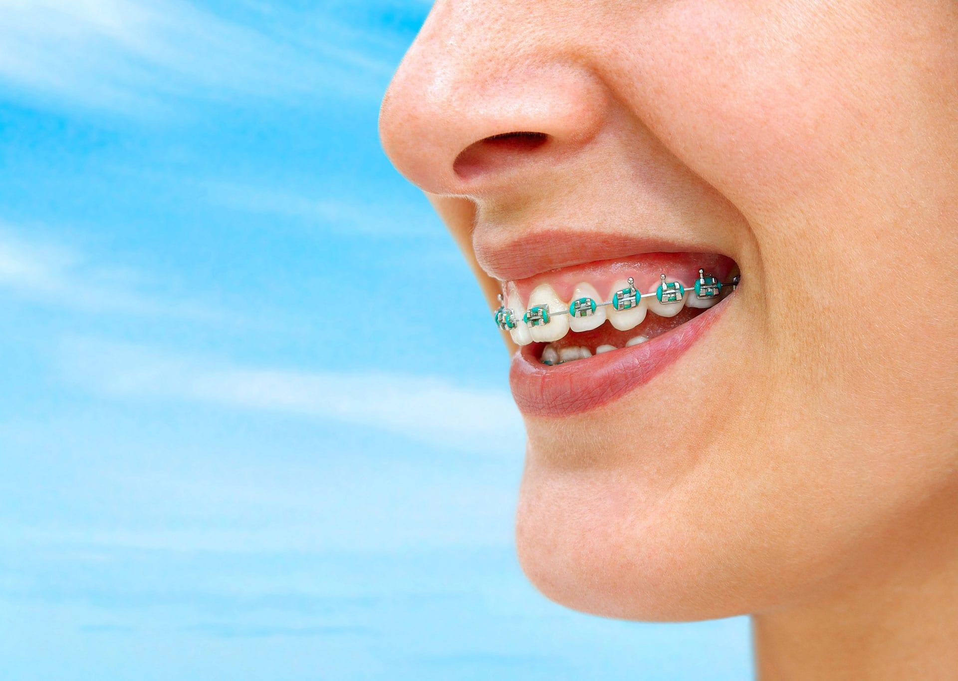 close up of teen girl with braces with a blue sky background