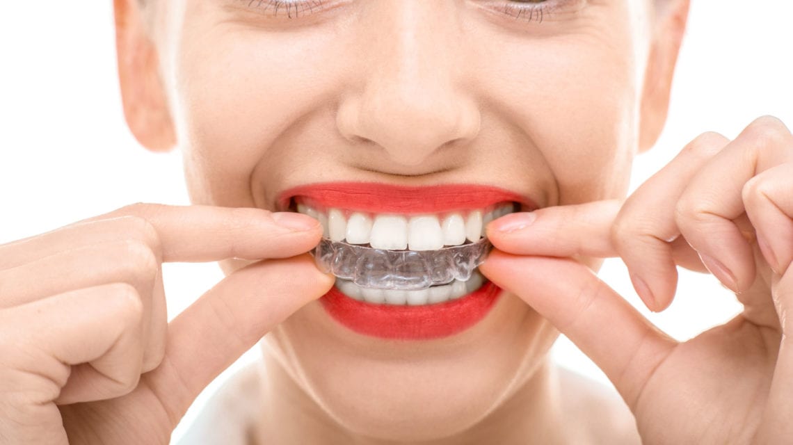close up of woman inserting a clear aligner