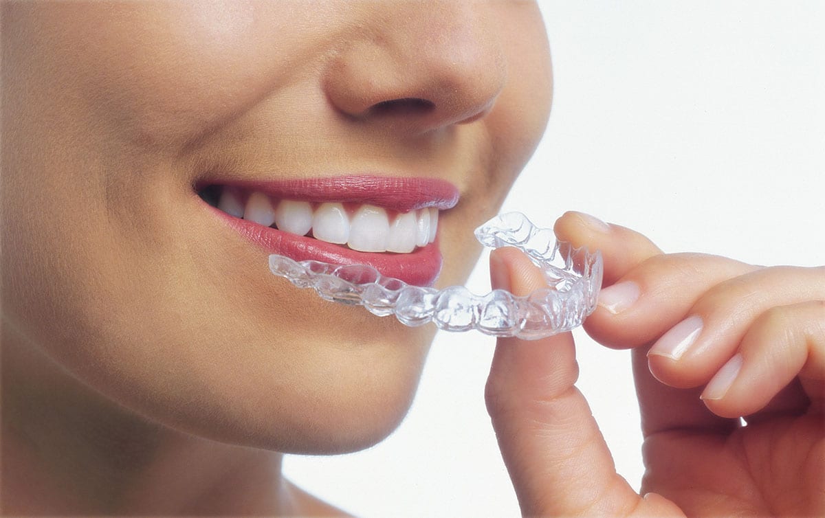 closeup photo of a woman inserting clear aligner into her mouth