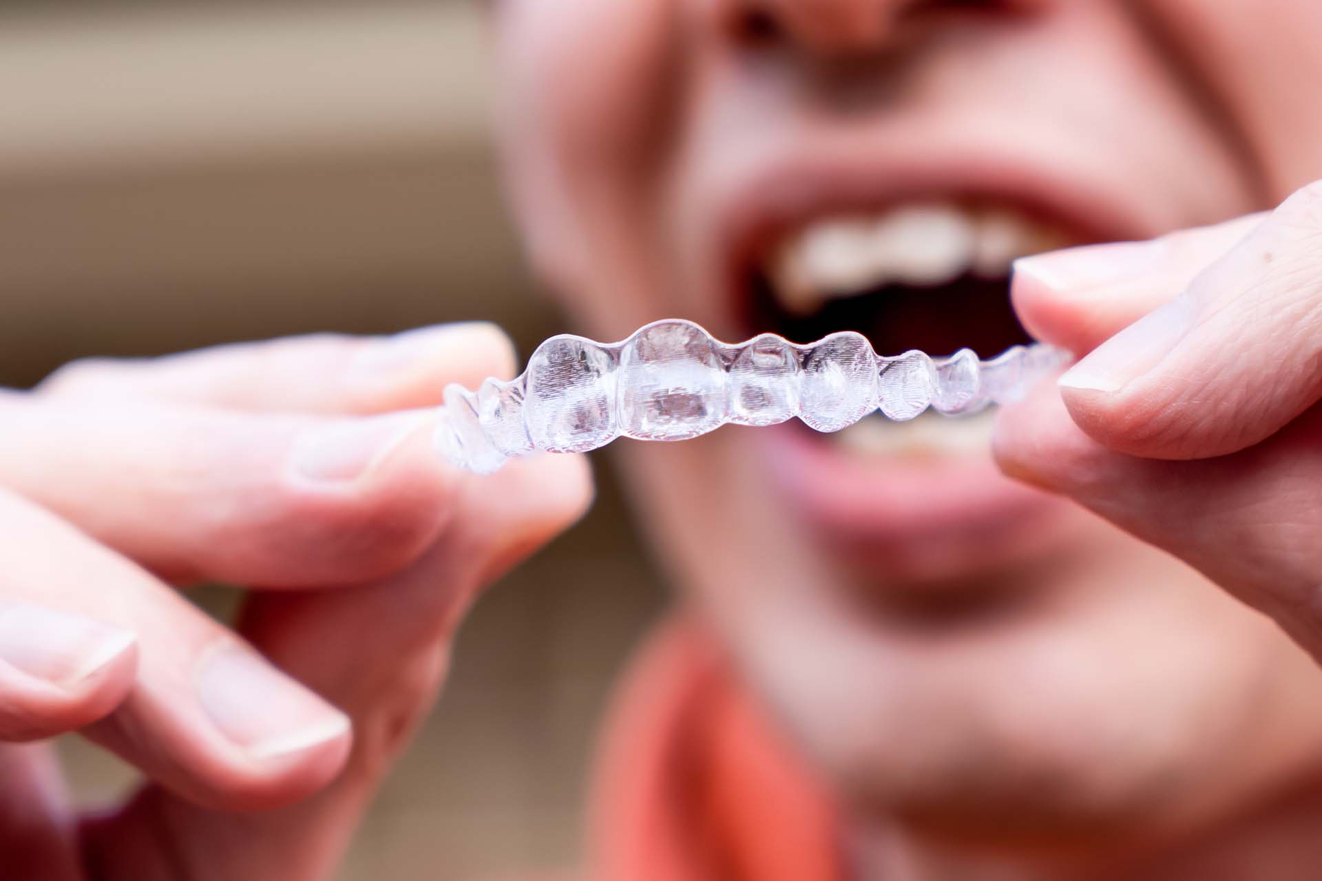 teen boy inserts invisible 3M Clarity orthodontic aligner to straighten his teeth