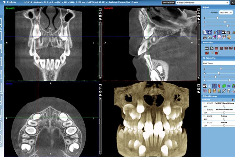 3D xray scans show the thickness of bone around each tooth to ideally treat patients with braces in Geo City