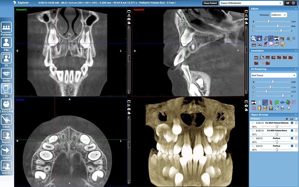 3D X-ray scans show the thickness of bone around each tooth Rancho Cordova, CA