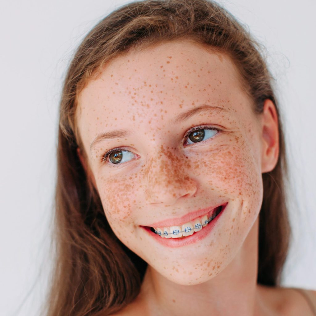 Arden Arcade girl smiling with traditional metal braces helpful to improve appearance