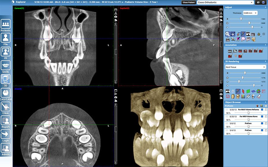3D xray scans show the thickness of bone around each tooth Carmichael 3D xray scans show the thickness of bone around each tooth Carmichael