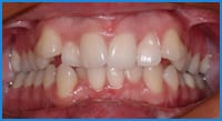 Athena's teeth before treatment Athena's teeth before orthodontic treatment